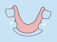 Diagram of headgear facebow and orthodontic brackets
