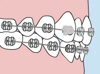Braces with loose wire and floss for temporary repair.