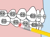 Poking wire illustration, pencil eraser pushing orthodontic wire.