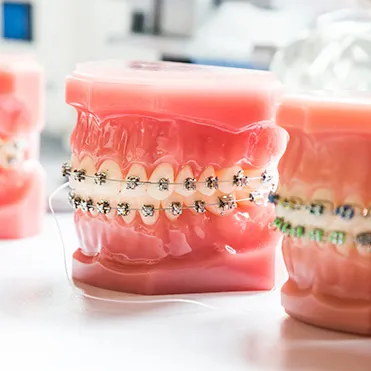 Traditional Braces
