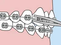 Braces with loose wire and tweezers for repositioning.