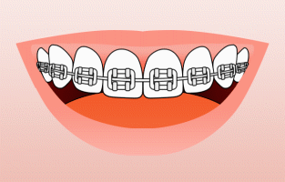 Animated illustration of teeth with braces demonstrating brushing and flossing techniques.