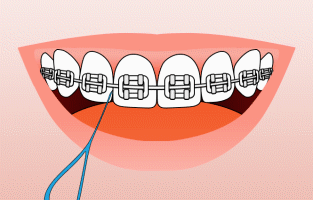 Flossing between teeth with braces using floss threader, demonstrating proper orthodontic hygiene.