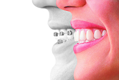 Invisalign clear aligners straightening teeth and creating a confident smile.